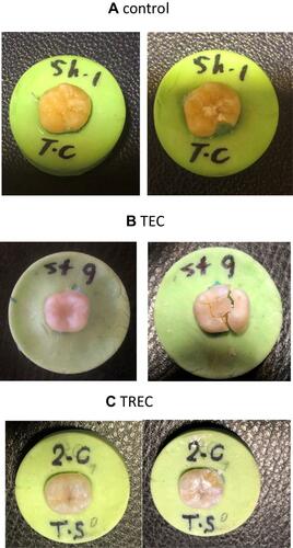 Figure 3 Photographs of the broken teeth in different groups of (A) control, (B) TEC, and (C) TREC.