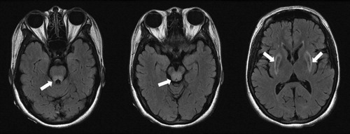 Figure 1. High signals of both basal ganglia, midbrain, and pons in fluid attenuated inversion recovery (FLAIR) modality (indicated with white-colored arrows).