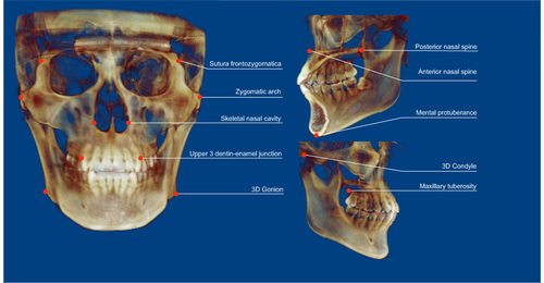 Figure 1 Measurements of craniofacial skeletal parameters on cone-beam computed tomography (CBCT). Maxillary length: distance between anterior and posterior nasal spine; anterior maxillary width: distance between left and right upper 3 dentin-enamel junction; posterior maxillary width: distance between the left and right maxillary tuberosity; mandibular width: distance between left and right 3D Gonion; mandibular total length: distance between the 3D condyle and mental protuberance; mandibular body length: distance between the angle of the mandible and mental protuberance; mandibular ramus height: distance between the 3D Gonion and condyle.