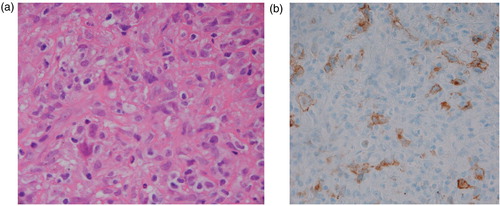 Fig. 1 (a) High power view of Level 7 lymph node from the neck showing atypical cells, some of which are multinucleated and consistent with Reed–Sternberg (RS) cells although not typical. (b) Immunohistochemical stain showing RS cells positive for CD30.