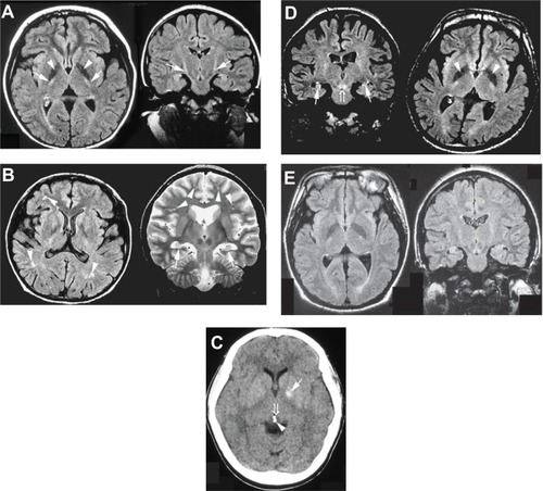 Figure 1 (A) FLAIR sequence of brain MRI at the age of 10 years (Case 1). The patient showed marked areas of low signal intensity in the pallidum (arrowhead) and areas of slightly high signal intensity in the pyramidal tract (arrow). (B) FLAIR and T2-weighted sequences of MRI at the age of 30 years (Case 2). The patient showed hippocampal atrophy (arrow) and diffuse mild ischemic changes in the cerebral white matter (arrowhead). (C) CT scan at the age of 28 years (Case 3). The patient showed calcification of the pallidum (arrow), pineal body (arrowhead), and habenular commissure (open arrow). (D) FLAIR sequences of MRI at the age of 26 years (Case 4). The patient showed hippocampal atrophy (arrow), marked areas of low signal intensity in the pallidum (arrowhead), and areas of increased signal intensity in the decussation of the superior cerebellar peduncles (open arrow). (E) FLAIR sequences of MRI at the age of 18 years (Case 5). The patient showed hippocampal atrophy.