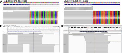 Figure 1 (A) NGS confirmed ALK fusion (EML4 exon 13–ALK exon 20, variant allele frequency was 4192); (B) EGFR 18 exon (c.2156G>C:55241708, p. G719A, abundance 74.8%); (C) EGFR exon 19 (c2239T>G:55242469, pL747V, abundance 70.05%).