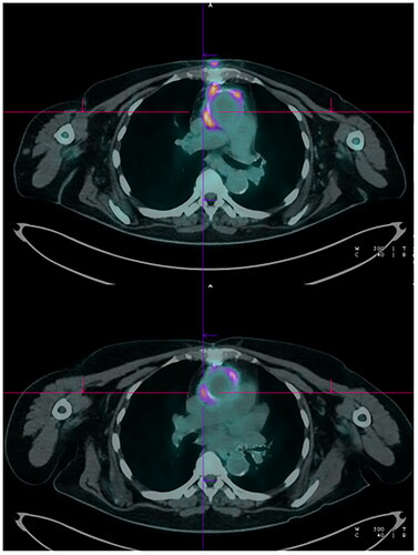 Figure 1. Case 1 PET-CT scan performed after 8 weeks of therapy is displayed in the upper part of the figure, showing focal increased uptake surrounding the aortic valve. In the lower part, follow-up PET CT after 8 months of SAT shows reduction of the uptake.