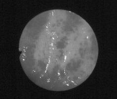 Figure 1 Endoscopic finding of Watermelon stomach—Endoscopic finding showed presence of erythematous, slightly elevated plaques above the gastric mucosa, confluent and radially disposed towards pylorus, resembling a watermelon bark (Watermelon stomach).