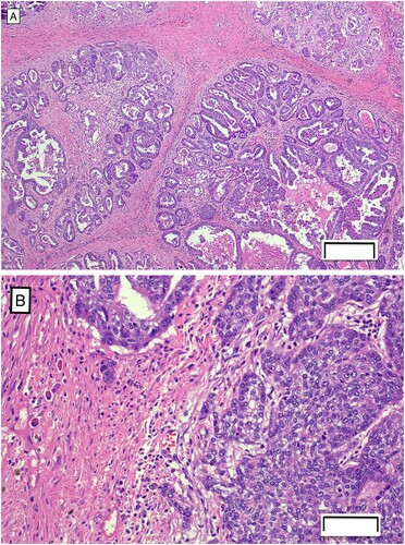 Figure 2. Photomicrographs of sections of mammary tissue from a Thoroughbred mare, showing (A) epithelial cells forming tubules and papillary projections within the neoplasia of the mammary tissue (H&E; bar = 200 µm) and (B) clusters of cells invading the basement membrane (H&E; bar = 50 µm).