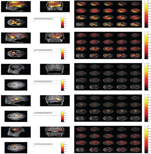 Figure 1 Neuronal activity maps with the face-perception data in session 5: The plots of the log-contrasts between the faces and scrambled faces on three orthogonal slices through the global peak locations and on 20 transverse slices under the scheme of sensor covariance estimation indexed by ma. The rows 1 and 2, 3 and 4, 5 and 6, 7 and 8, and 9 and 10 are for the SAM, LCMV, LCMV4, depth-weighted MNE, and TAB, respectively. In each subplot, the scale of the log-contrasts between the faces and scrambled faces are normalized to their maximum value and the log-contrasts have been thresholded by zero below. The highlighted yellow colored areas show neuronal activity increases for the faces relative to the scrambled faces. All the subplots are overlaid on the anatomical MRI scan of the brain.