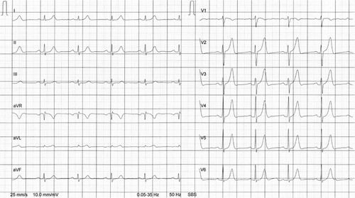 Figure 1 ECG at rest from brother A.