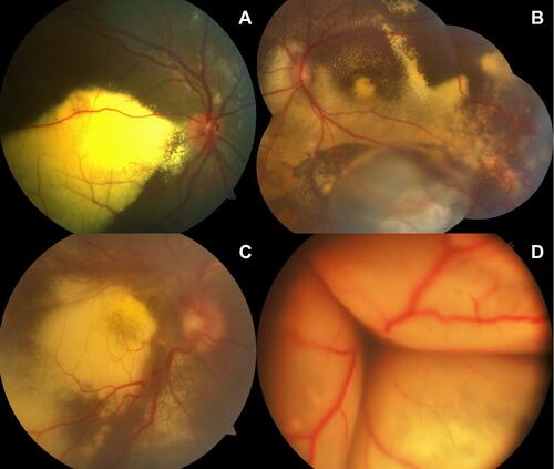 Figure 1 Colored fundus photographs of different stages of presentation from our analyzed patient sample of exudative Coats’ disease, (A) stage 2B with telangiectasia and exudation involving the fovea, (B) stage 3A1 with ERD not involving the fovea, (C) stage 3A2 with ERD involving the foveal region, and (D) stage 3B with total ERD taken by RetCam.