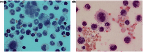Figure 3. Smear of the ascitic fluid in rat with transplanted ovarian cancer. (A) The image depicts cyst of ovarian adenocarcinoma, cell mitosis and cell necrosis. (B) Haemorrhagic ascetic fluid contains large malignant cells with basophilic cytoplasm, nucleus mitosis, extensive cytoplasm vacuolisation and pseudopods on the external cytoplasmic membrane.