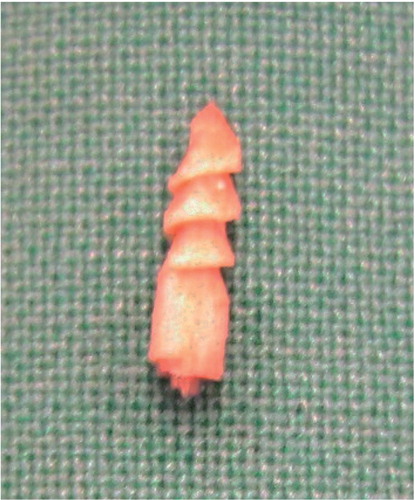 Figure 1. A POGLICO-SHS implant (birch screw).