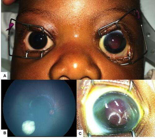 Figure 4 Bilateral Retinoblastoma presenting with buphthalmos of the left eye (A and C) and an intraocular lesion in the right eye (B).