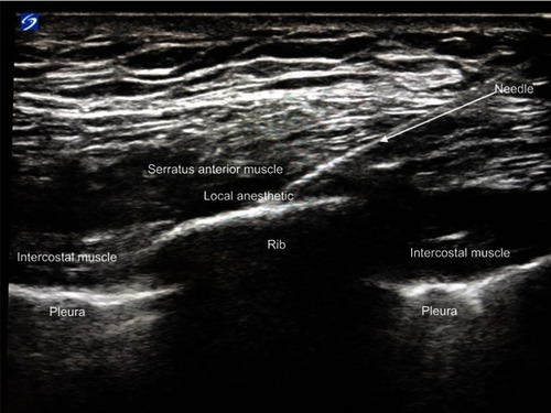 Figure 1 Ultrasound image of the chest wall – the ribs and pleura are identified. Tilting the ultrasound probe allows for visualization of the border between ribs, intercostal, serratus anterior, and latissimus dorsi muscles to allow for proper placement of local anesthetic and/or catheter.