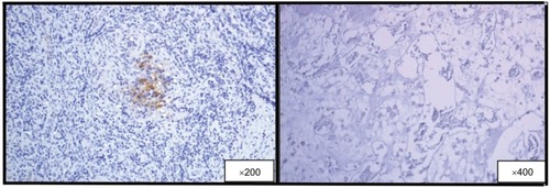 Figure 2 Left: positive reaction with the monoclonal anti-p24 antibody in lymph node tissue from an HIV-positive patient during HAART (positive control). Right: negative reaction in bone tissue from an HIV-positive patient with osteonecrosis during HAART and undetectable viral load.