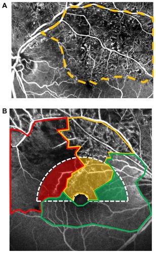 Figure 1 (A) Fluorescent angiogram of branch retinal vein occlusion that contains partial perfusion areas showing clusters of small fragmented areas of hypofluorescence with dilation and irregular capillary network patterns (microcapillary loss between the remaining dilated capillaries). (B) Fluorescent angiogram shows the perfusion status around the macula.