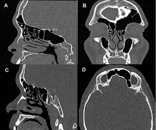 Figure 1 Computed tomography (CT) of paranasal sinuses showing identification of frontal recess cells based on International Frontal Sinus Anatomy Classification. (A) The sagittal computed tomography (CT) image shows a supra agger frontal cell – SAFC (filled square) above the agger nasi cell – ANC (filled circle) and extends into the frontal sinus; (B) A supra agger cell (filled star) is seen above the ANC (filled circle), a frontal septal cell (FSC) (filled diamond) located in the interfrontal sinus septum on the coronal CT image; (C) The sagittal CT image illustrates a supra bulla cell (SBC) (indicated by +), which is above the ethmoid bulla (EB) (filled triangle), a supra bulla frontal cell (SBFC) (solid arrow) pneumatizes along the skull base; (D) The supraorbital ethmoid cell (SOEC) (asterisk) pneumatizes over the orbit and around the anterior ethmoid artery (axial CT image).