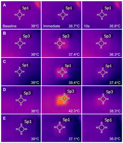 Figure 1 Thermal imaging camera study. Images were captured at baseline, immediately, and 10s after bipolar radiofrequency (RF) treatment at a frequency of 1 MHz. The experimental settings were (A) a power of 4W, a conduction time/pulse pack of 200 msec, and a single pulse pack; (B) 12W, a conduction time/pulse pack of 200 msec, and a single pulse pack; (C) 12W, a conduction time/pulse pack of 600 msec, and a single pulse pack; (D) 12W, a conduction time/pulse pack of 100 msec, 2 pulse packs, an off-time between pulse packs of 50 msec, and a total conduction time of 200 msec; and (E) 12W, a conduction time/pulse pack of 100 msec, two pulse packs, an off-time between pulse packs of 20 msec, and a total conduction time of 200 msec. The thermometric values of baseline tissue were adjusted to 36°C.