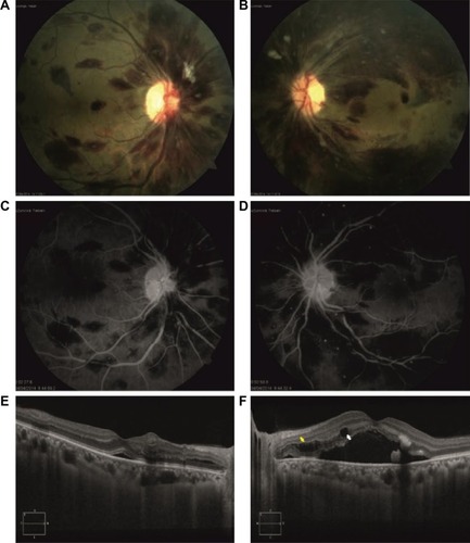 Figure 1 At presentation, BCVA of a 52-year-old male patient with multiple myeloma was 20/50 in the right eye and 20/800 in the left eye.