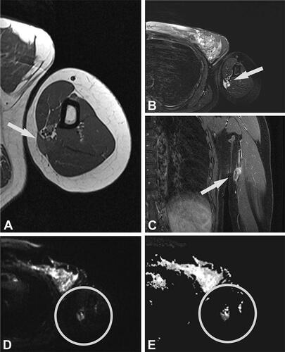 Figure 3. Case no. 7. A 40-year-old female with an epifascial soft tissue lesion of the upper arm. (A) On a T1-weighted image, the lesion with intermediate signal intensity and irregular margin; wide contact with the underlying fascia (arrow). (B) Homogenous high T2-weighted signal intensity without any surrounding edema (arrow). (C) Coronal T1-weighted image with fat saturation after application of Gd-contrast shows heterogeneous contrast enhancement (arrow). (D–E) DWI image (D) with corresponding (E) ADC map shows diffusion restriction due to necrotic collection (circles).