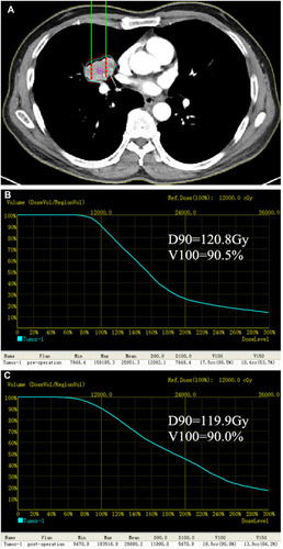 Figure 1 Preoperative treatment planning system (TPS). (A) Red line represented the tumor’s contour, the planning target volume edge was covered by the isodose curve from 70 to 90%. (B) Preoperative dose-volume histograms (DVH). The prescription dose (PD) was 120Gy, a total of 90% of the tumor target (D90) received 120.8Gy and 90.5% of the tumor received 100% of the prescribed dose (V100). (C) Postoperative DVH. After 125I brachytherapy, the dose intensity was verified, D90 = 119.9Gy and V100 = 90.0%.