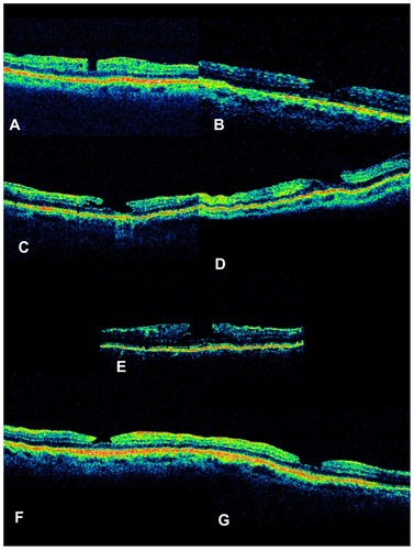 Figure 1 (A–F) OCT images of the six patients that developed lamellar macular holes after rhegmatogenous retinal detachment repair. (G) OCT imaging of the macula of the fellow eye of patient imaged on (F). Note also the presence of a lamellar macular hole.
