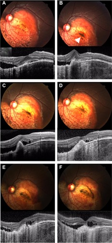 Figure 5 Photograph and spectral domain optical coherence tomography findings for case 3.