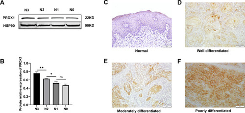 Figure 6 The relationship between PRDX1 level and N stage and pathological grade was further verified by Western blot and IHC staining. (A and B) the expression level of PRDX1 in different N stage by western bolt; (C–F) the expression level of PRDX1 in different pathological grade by IHC staining. (*P<0.05; **P<0.01)