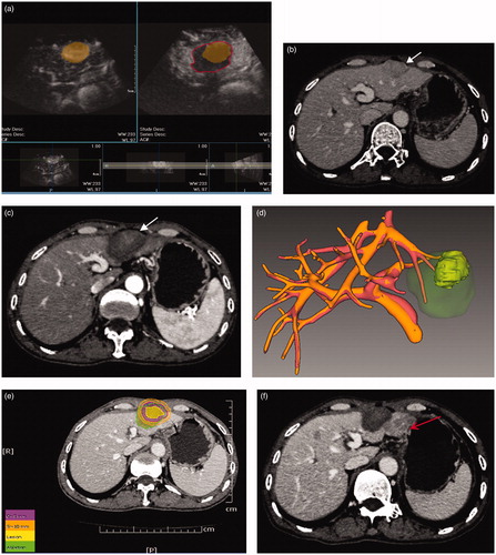Figure 4. 3DCEUS and CT fusion of an insufficient ablative margin in a 57-year-old man with HCC. (a): The ablation zone (marked in red line) covered the tumor (marked in orange) completely after 3DCEUS fusion, but 5 mm ablative margin was not achieved on the upper-left (Quadrant 1) of the tumor. (b): CECT obtained before RFA showed a low-attenuating tumor (arrow) in venous phase. (c): CECT obtained 1 month after RFA showed the ablation zone in arterial phase. The treatment response was considered complete ablation. (d): CT fusion showed the tumor was covered by translucence ablation zone (green) successfully, but it was an eccentric overlap. (e): The pre-RFA tumor was overlaid on the post-RFA images. It was shown that ablative margin was insufficient on Quadrant 1 as the ablation zone margin (green) intersected with the tumor margin and did not cover 5 mm ablative margin area (purple). (f): CECT obtained 7 months after RFA shows LTP as peripheral hypo-enhanced lesion (arrow) adjacent to the treated area in venous phase. LTP occurred in the section where 5 mm ablative margin was not achieved.