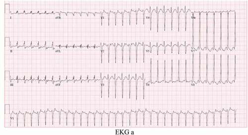 EKG a EKG after cardio-version reverting AVNRT to sinus rhythm
