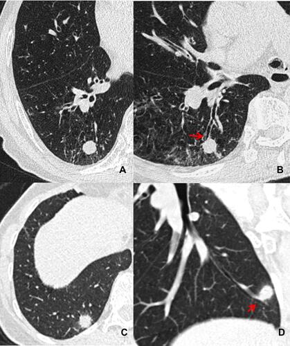 Figure 4 Differentiation between pSCLC and inflammatory lesions (pIL). Axial and reconstructed CT images in a 78 year old male with pSCLC show a round nodule with smooth margin, homogeneous density (A), and the bronchial cutoff sign (red arrow) is also detected (B). Axial and reconstructed CT images in a 46 year old female with pIL show a round nodule with spiculation (C) and peripheral GGO (D) but without bronchial cutoff sign (D).