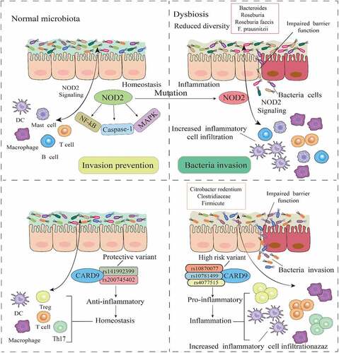 Figure 1. Gut bacteria-associated gene mutations in IBD. In a normal intestinal environment, the gut microbiota interacts with immune components via NOD2 to prevent infection. However, mutations in NOD2, which invariably affect the MAPK, NF-kβ, and caspase-1 pathways, influence microbial response, and promote low diversity and dysbiosis in the microbiome, leading to an impaired mucosal barrier function and bacteria invasion. As a key regulator of microbiota in the intestine, the dysfunction of NOD2 signaling correlates with certain gut bacteria. Mutations in CARD9 genes are also associated with certain gut bacteria, where mutation into high-risk and proinflammatory variants drive dysbiosis, impair barrier function, and increase inflammatory cells and cytokines.