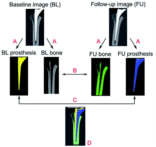 Figure 1. Schematic representation of the proposed method. A. Segmentation of the bone and prosthesis images based on the source images. B. Bone registration. C. Prosthesis registration. D. Quantification of the migration and its visualization.