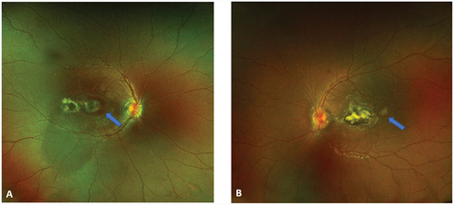 Figure 1. Fundus color photography of patient 1 demonstrated parafoveal fibroglial scars on OD (A) and foveal fibroglial lesions on OS (B). Note the presence of subretinal hemorrhages (arrows) suggestive of CNV.