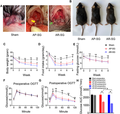Figure 1 Sleeve gastrectomy (SG) alleviates obesity and glucose metabolic disorders in obese and T2D model. (A) Illustration of sham, antrum preservation SG (AP-SG) and antrum resection SG (AR-SG) operation. The resection line started 1 cm from the pyloric ring (yellow arrow). The resection line started as close as possible near the gastroduodenal junction (green arrow). D = duodenum; A = antrum; S = stomach. (B) Eight weeks after operation, representative appearances of mice in sham, AP-SG and AR-SG group are recorded. Illustrates changes in body weight (C), food intake (D), fasting glucose level (E) after operation. Oral glucose tolerance test (OGTT) results preoperative (F) and postoperatively (G), and area under the curve (AUC) for glucose level (H) are presented. Data (n = 8) are shown as mean ± SD. *Significant AP-SG compared with sham (P < 0.05). ^Significant AR-SG compared with sham (P < 0.05). #Significant AR-SG compared with AP-SG. aP< 0.05.