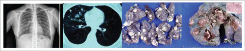 Figure 1. Chest X-ray and CT (CT) demonstrated diffusely round-shaped nodules in the upper, middle and lower lobes of the right lung (A and B). Grossly, multiple demarcated nodules with a maximum diameter up to 2.5 cm within the lung parenchyma (C) and some nodules located just beneath the visceral pleura (C and D).