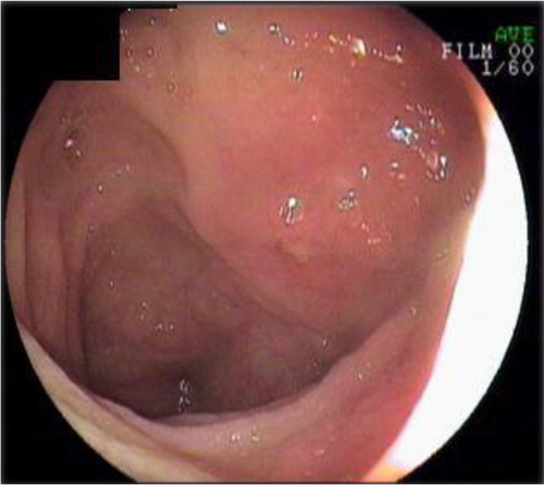 Fig. 2 Aphthous ulcers on terminal ileum.