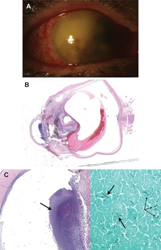 Figure 2 (A) Slit lamp photograph of case 2 at presentation showing corneal edema, and a complete hypopyon with dense fibrin within the anterior chamber. (B) Histopathology of case 2 displays a centrally gathered and detached retina with inflammatory material present within the anterior chamber and anterior vitreous. (Hematoxylin-eosin staining, original magnification ×40). (C) Histopathology on the left indicating area of collection in the anterior chamber, highlighted in the image on the right showing the contents of the anterior chamber displaying septated fungal hyphae consistent with Aspergillus.