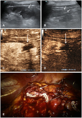 Figure 2 Features of US and CEUS of a patient with a band-like spot of the contrast agent extravasation. A 69 years-old woman with 3×3cm diameter solid tumor underwent RANSS. (A) Conventional US displayed a hypoechoic small mass located in the upper pole of the left kidney before surgery (arrows). (B) On postoperative day 1, conventional US demonstrated the wound as a hollow on the renal surface (arrows). (C) On postoperative day 1, in the medullary phase CEUS demonstrated a band-like spot of the contrast agent extravasated from the wound to the filling defect which represented the effusion (arrow). (D) The extravasation could not be detected on postoperative day 2 (arrow). (E) The area of renal wound exstrophy which showed the unsatisfactory closure after continuous suture may be the site of contrast agent extravasation (arrow).