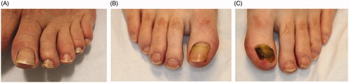 Figure 10. Clinical presentations of Beau’s lines, onychomadesis and retronychia. (A) Beau’s lines on the left toenails. (B) Onychomadesis of the left great toenail. (C) Retronychia of the right great toenail.