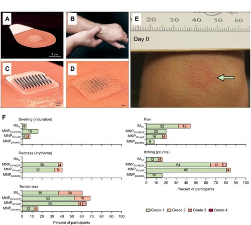 Figure 3 Representative images of the DMN containing influenza vaccine employed during the Phase I trial. (A) Each DMN contained 100 microneedles, 650 µm in height, mounted on an adhesive backing and (B) the DMN was manually administered to the wrist, enabling self-administration by participants in the study. (C–D) Post insertion in the skin, the DMN dissolved thus delivering the influenza vaccine in the skin layers, represented here by a blue dye. (E) Some local reactions were evident in the skin post DMN insertion. (F) Local reactions associated with vaccination in the different groups are shown. Adapted from The Lancet, vol 190 (10095), Nadine G Rouphael, Michele Paine, Regina Mosley et al, The safety, immunogenicity, and acceptability of inactivated influenza vaccine delivered by microneedle patch (TIV-MNP 2015): a randomised, partly blinded, placebo-controlled, phase 1 trial, pages 649-658, Copyright (2017), with permission from Elsevier.Citation18