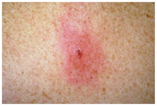 Figure 1 Erythema migrans patient A at day 3 (biopsy day).