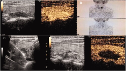Figure 2. Female, 49 years old, diagnosed as primary hyperparathyroidism. (PTH: 137 pg/ml, serum calcium: 2.74 mmol/L, serum phosphorus: 0.80 mmol/L). (A) Contrast-enhanced ultrasonography showed that a hypoechoic nodule behind the left thyroid lobe was highly enhanced in arterial phase; (B) MIBI showed radioactive concentration in the lower left lobe of thyroid and revealed parathyroid adenoma; (C) Microwave antenna was placed into the nodule under US guidance after hydrodissection was performed; (D) After ablation, contrast-enhanced ultrasonography showed the nodule no enhancement.