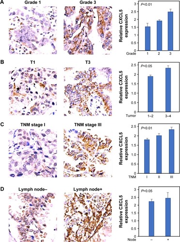 Figure 2 Association of CXCL5 expression with pathological parameters in adenocarcinoma by immunohistochemical staining.
