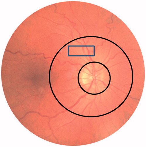 Figure 1. Retinal sample in the juxtapapillary area of a study participant.