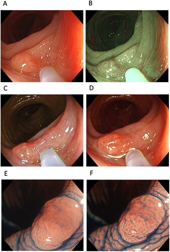 Figure 6. Cases of colon polyp. A tumour in one case observed using (A) white-light imaging (WLI), (B) narrow-band imaging, (C) texture and colour enhancement imaging (TXI) mode 1 and (D) TXI mode 2. A polyp observed in another case using (E) magnified endoscopy with indigo carmine (ICME)-WLI and (F) ICME-TXI mode 1.