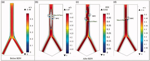 Figure 13. The velocity and lesion zone distribution of renal artery before and after RDN. (a) Before RDN, (b) Balloon-based RDN, (c) Spiral-RDN, (d) Monopolar-RDN.