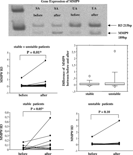 Figure 1.  A representative polyacrylamide gel with RT-PCR products of MMP9 from human saphenous veins sampled before and after surgical preparation for CABG from patients with stable (SA) or unstable angina (UA). The band densities were measured and the ratio between test genes and reference gene H3 were calculated in total of 24 patients (12 stable, 12 unstable). MMP9 gene expression for stable and unstable patient groups jointly and separately is illustrated by dot-plots, showing the individual change from the first to the second biopsy. The difference in MMP9 between the second and first biopsy is illustrated by a box-plot for each group. Gene expression of MMP9 was increased after surgical handling in all patients. When the patients were subdivided into populations of stable and unstable angina, MMP9 gene expression was significantly increased in veins from stable, but not unstable patients. Note that the scale of relative gene expression on the dot-plots are different.