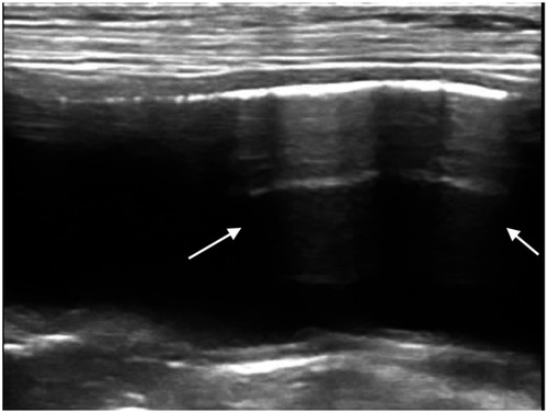 Figure 2 Ultrasonographic longitudinal scan of the urinary bladder with emphysematous cystitis by E. coli in a diabetic 14-year-old female English setter dog. Multiple reverberation artifacts are present within the bladder lumen (arrows).