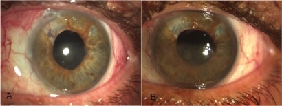 Figure 1 Case 1 A) On presentation and B) after first injection. Regression of iris neovascularization.