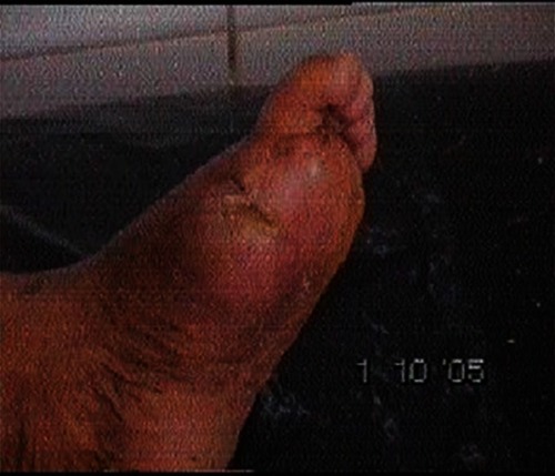 Photo 4 Lesion of patient 2 after 2 months of treatment.