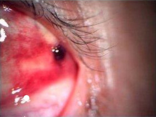Figure 3 Eye showing subconjunctival hemorrhage.